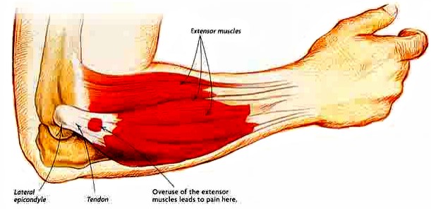 Tennis Elbow Diagram